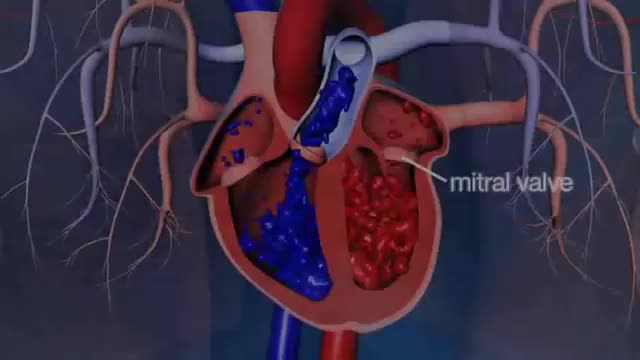 Mitral valve regurgitation