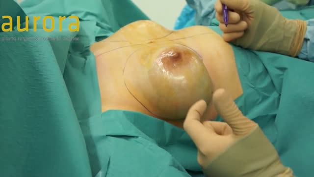 Removal and Replacement with Breast Capsulectomy