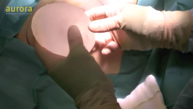 ⁣Breast Implants Exchange Surgery