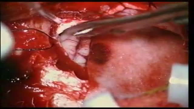 microneurosurgical microvascular decompression in trigeminal neuralgia