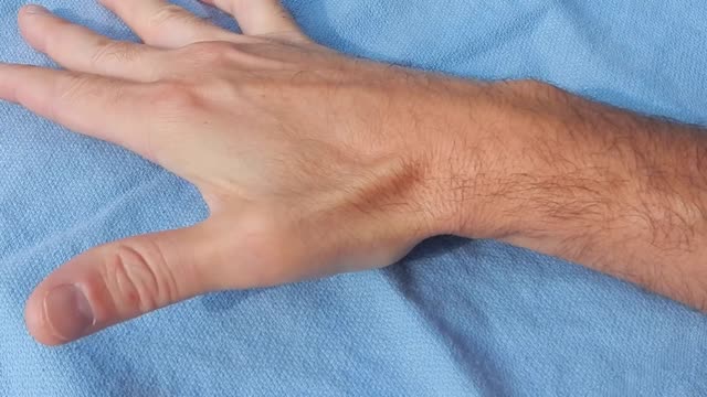 De Quervain's Tenosynovitis