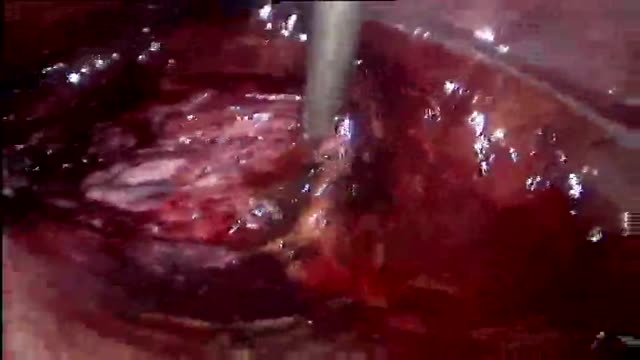 ⁣Hysterectomy - uterine vessels secured with staples