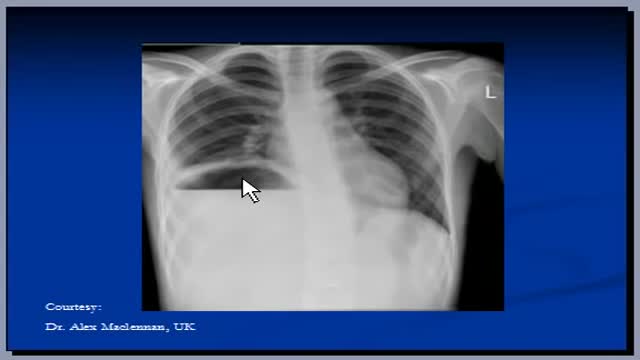 Subphrenic abscess CXR