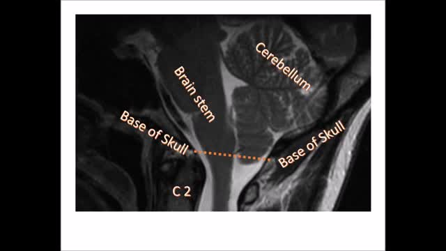 Chiari Malformation & Syringomyelia