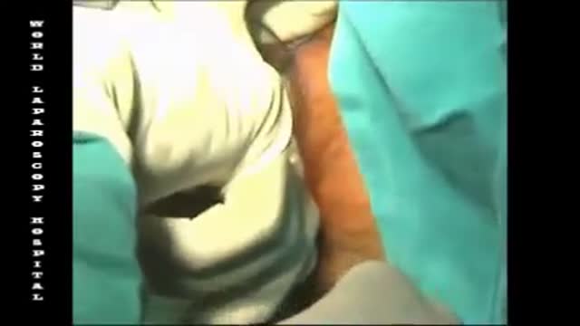 Stapled Hemorrhoidectomy