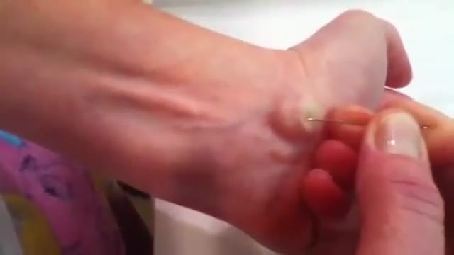 ⁣Popping a ganglion cyst