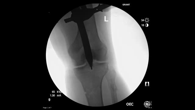 ⁣Suprapatellar Tibial Nailing for Segmental Tibia Fracture