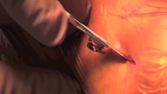 Removal of a Broken Intramedullary Nail from Tibia