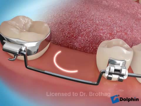 Molar Uprighting for Implant