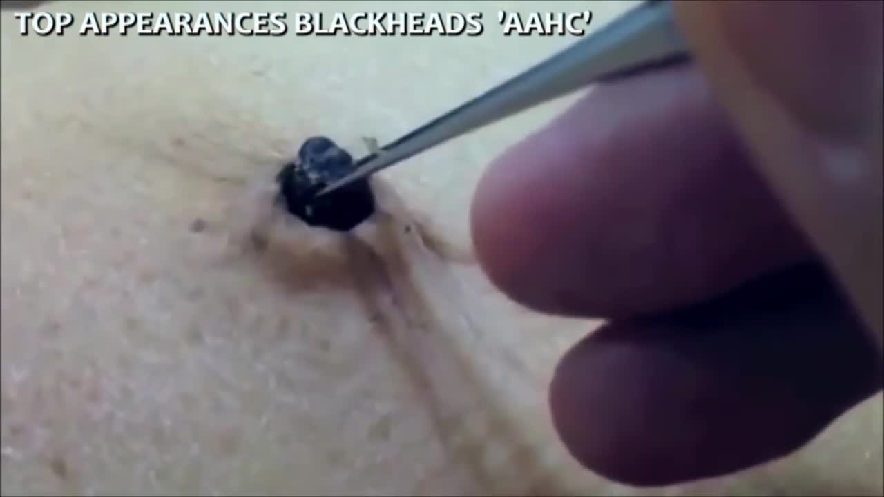 Cysts, Zits, Pimples & Blackhead Popping