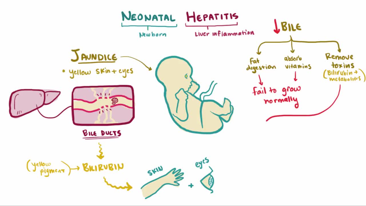 ⁣Neonatal & idiopathic hepatitis