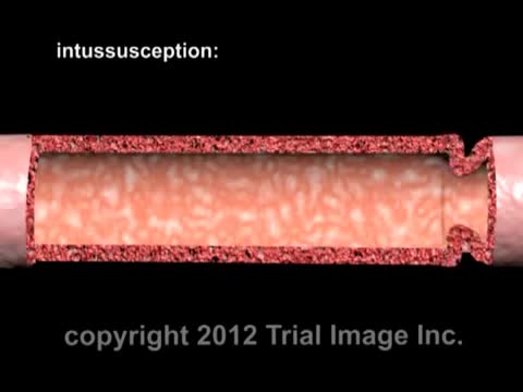 Intussusception