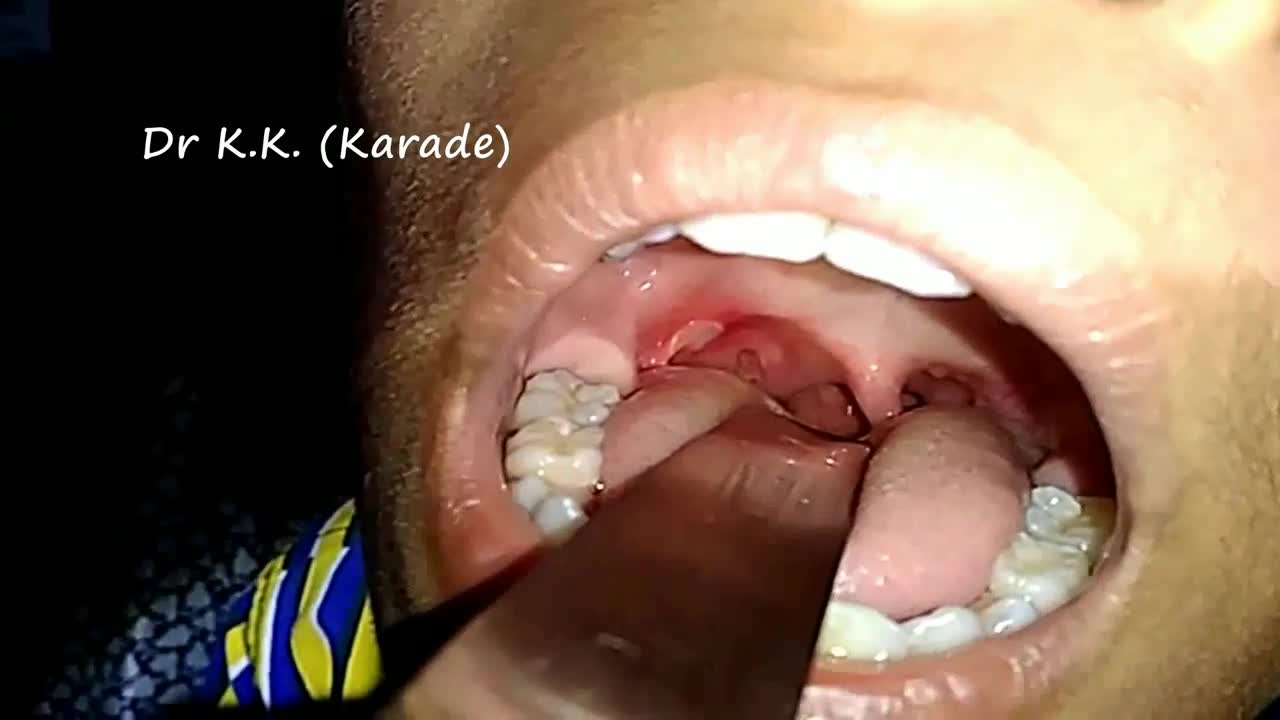 ⁣Canker Sore or Aphthous ulcer