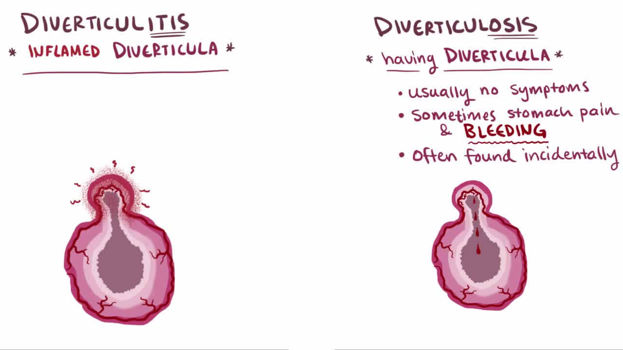 ⁣Diverticula, diverticulosis, & diverticulitis