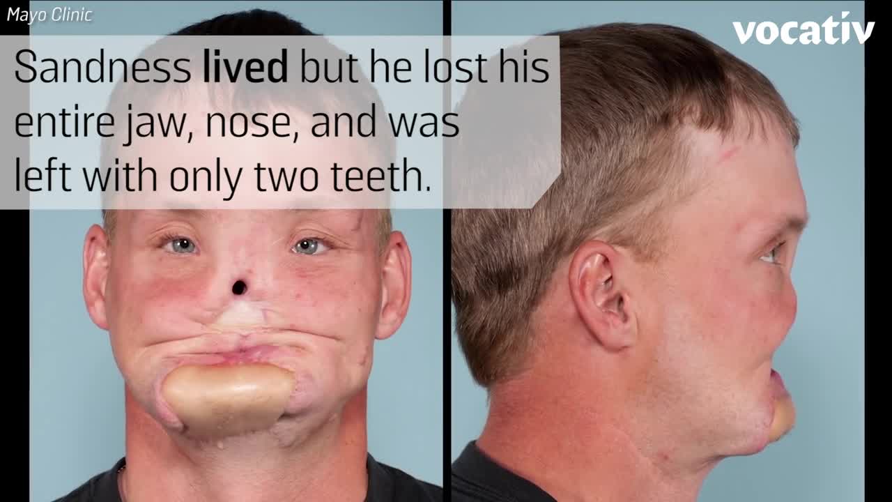 ⁣3D-Printing Helped This Man Get A New Face