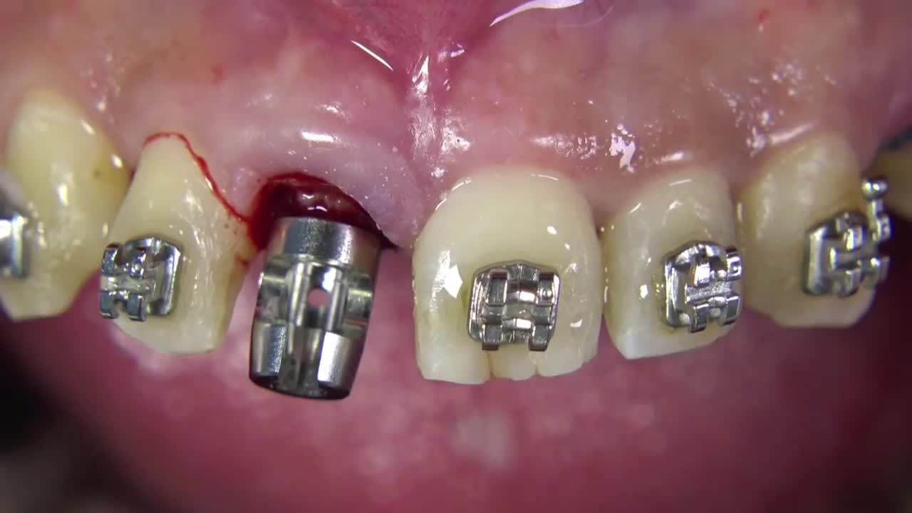 ⁣Minimal traumatic tooth extraction