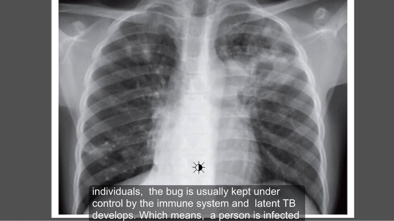 ⁣Tuberculosis, Active TB , Chest x ray