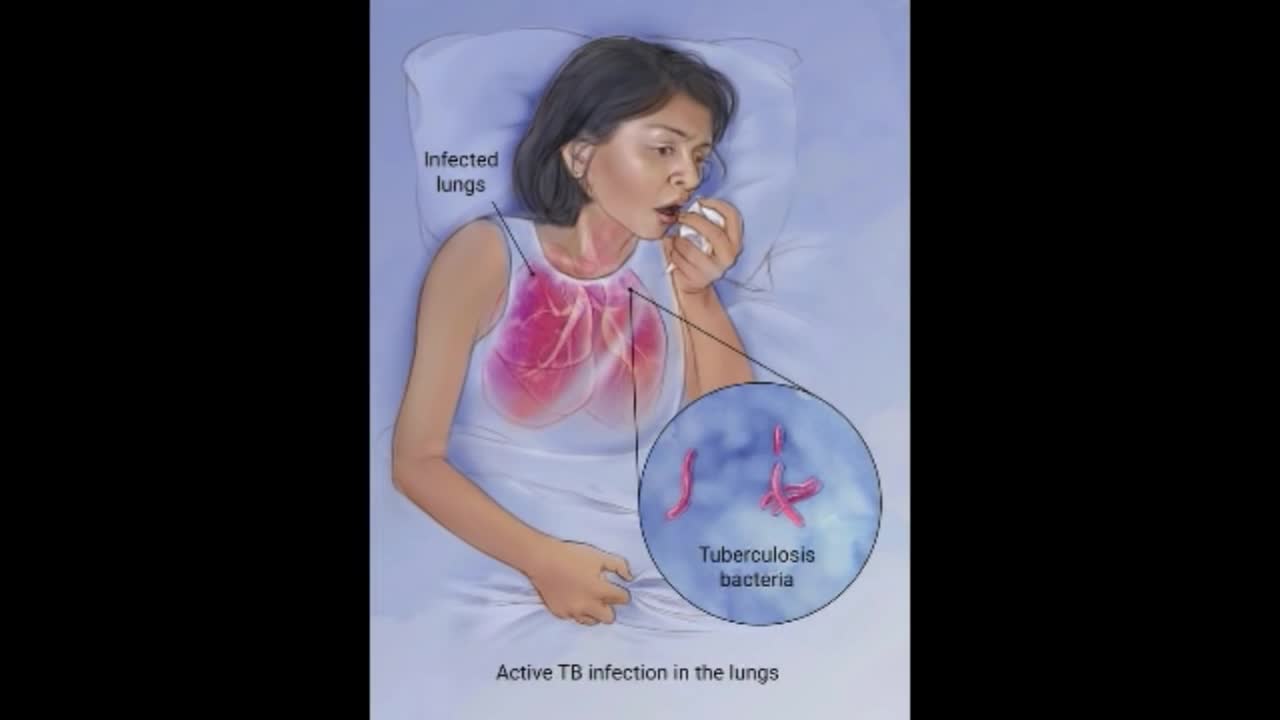 ⁣Tuberculosis Disease TB