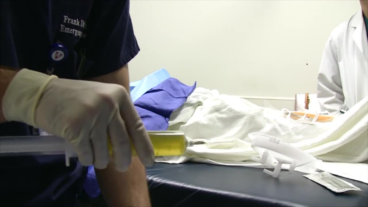 ⁣Peritoneal Tap to Drain Ascites Fluid