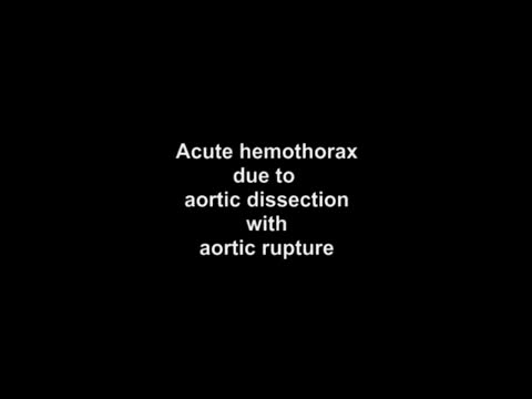⁣Hemothorax due to aortic rupture in aortic