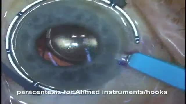 McCannel Suture fixation of IOL to iris using standard and Sipser-chang technique