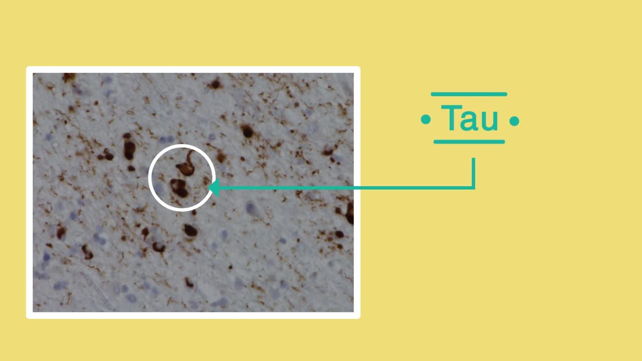 ⁣What is frontotemporal dementia?