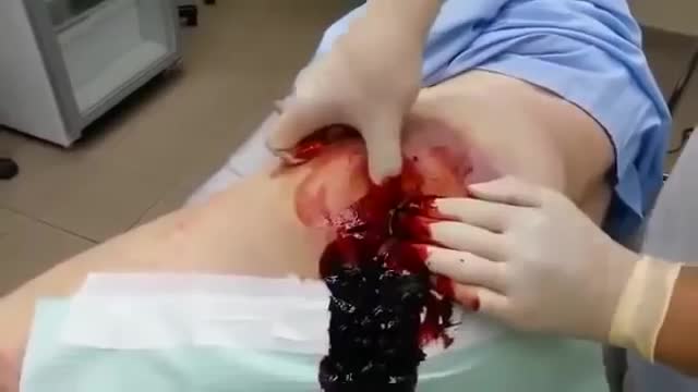 ⁣Jelly Abscess on the Butt