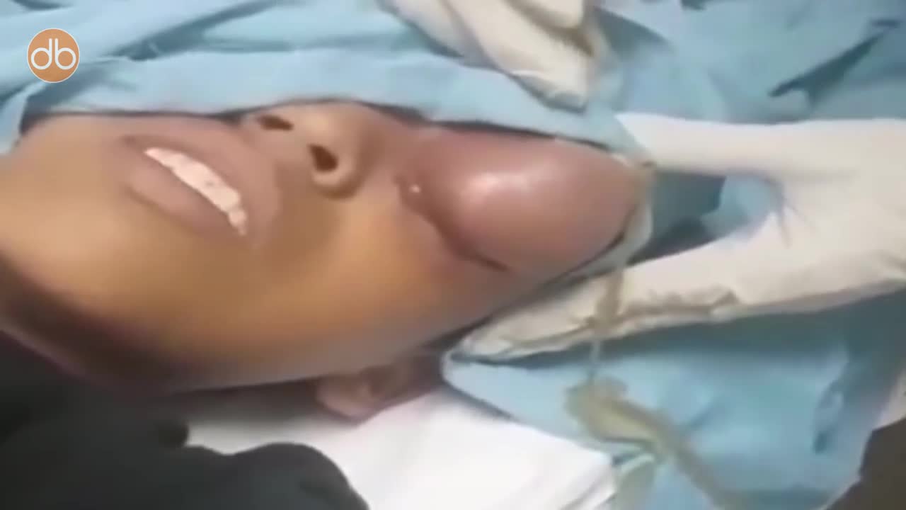 ⁣Popping Giant Eye Cyst