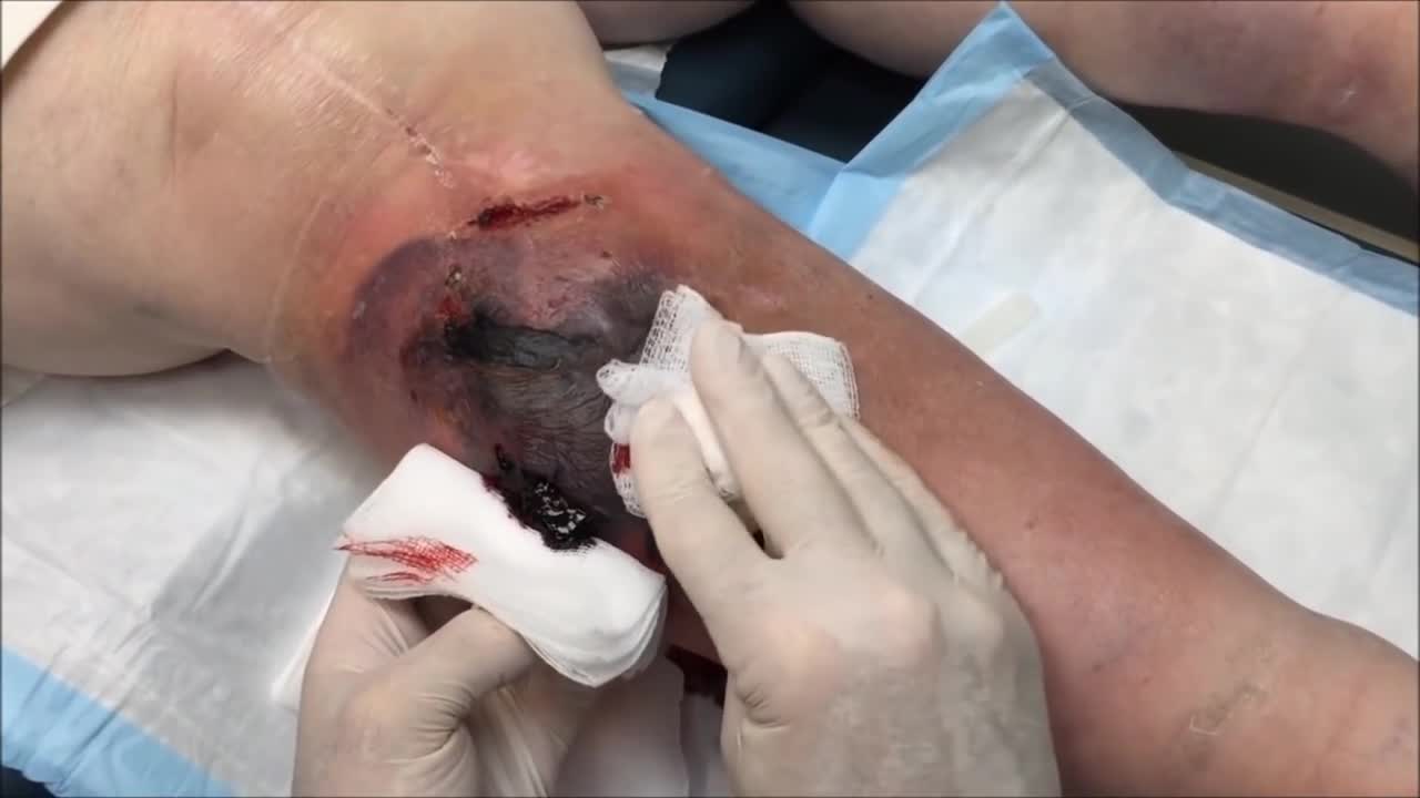 ⁣Sebaceous Cyst, Hematoma and Growth Removal 