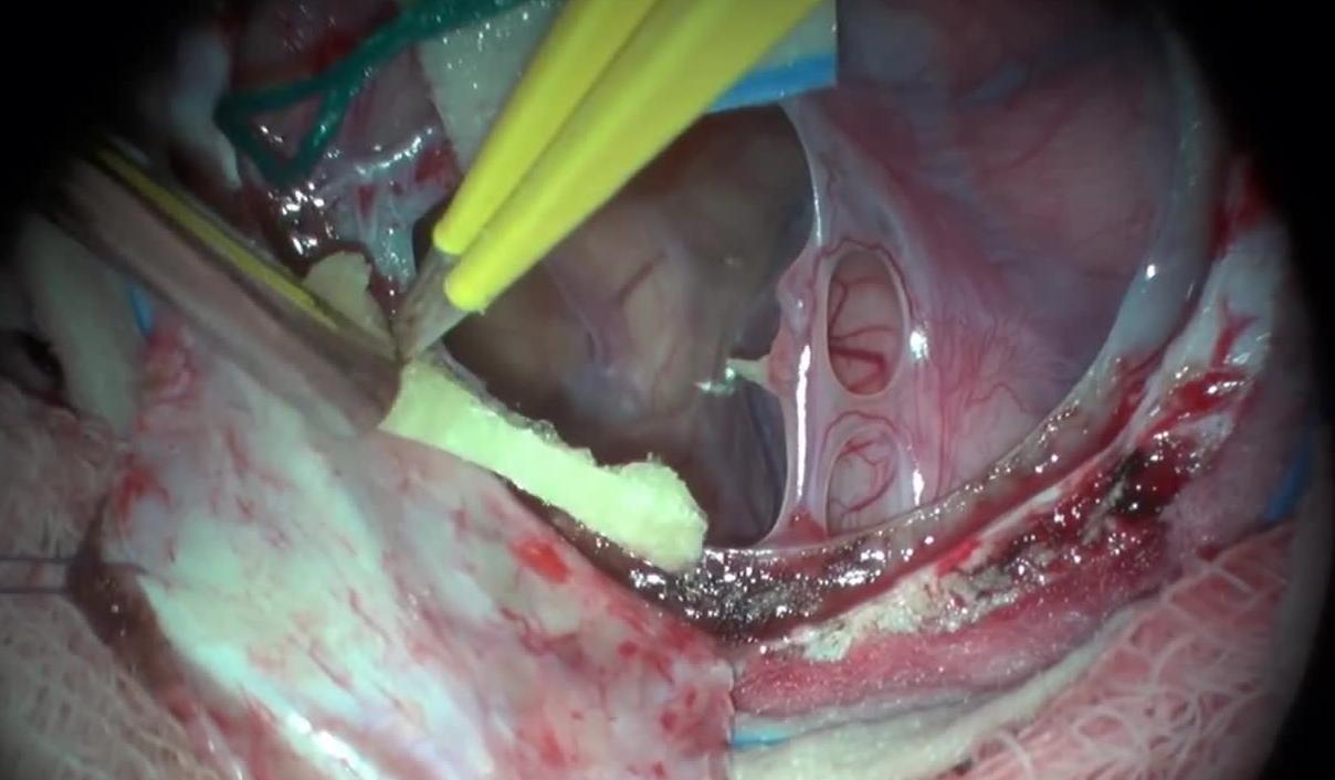 Arachnoid Cyst with Accompanying Subdural Hygroma