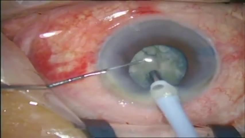 ⁣Hard Cataract with a Small Pupil
