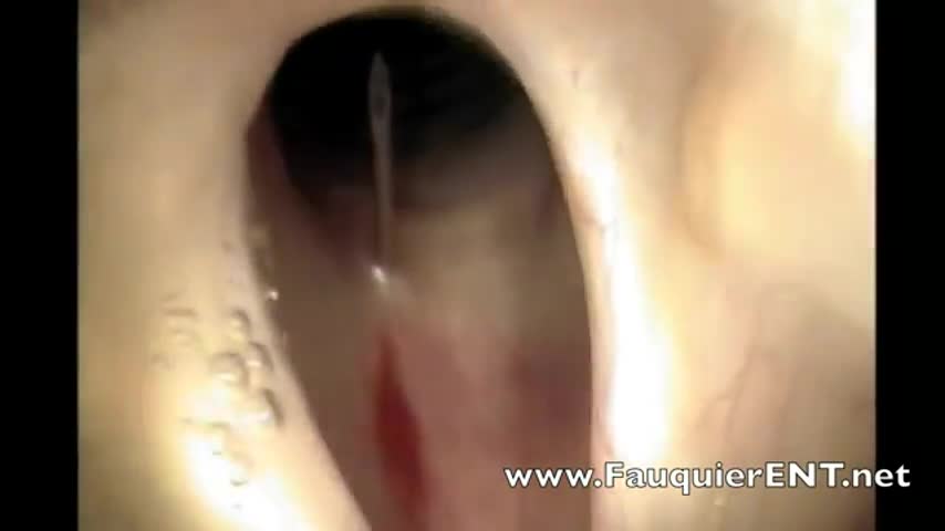 Endoscopic Injection of Vocal Cord Mass & Bronchoscopy Without Sedation