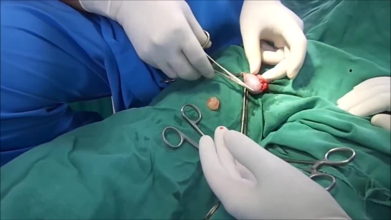 Epidedymal Cyst Surgery