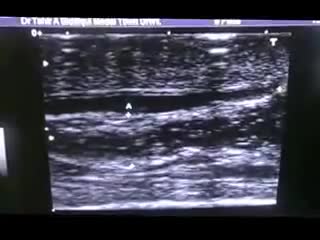 ⁣SPERMATOCELE vs EPIDIDIMAL CYST