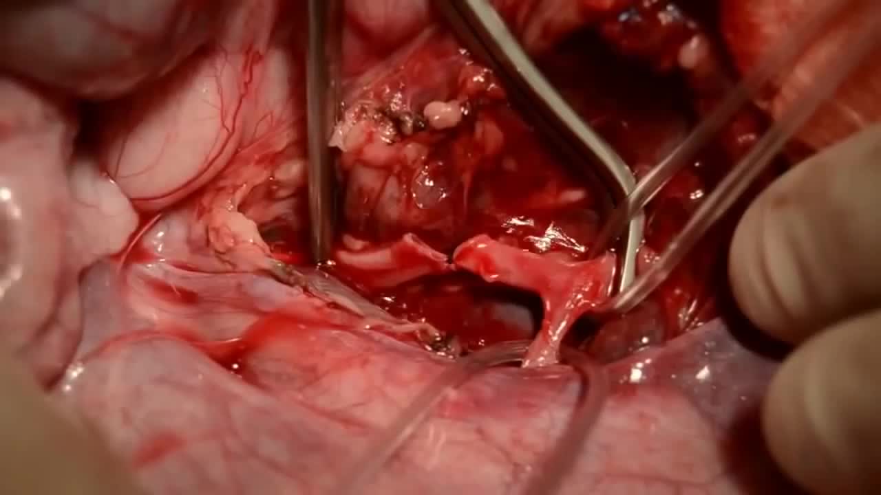 ⁣Arterial Anastomosis