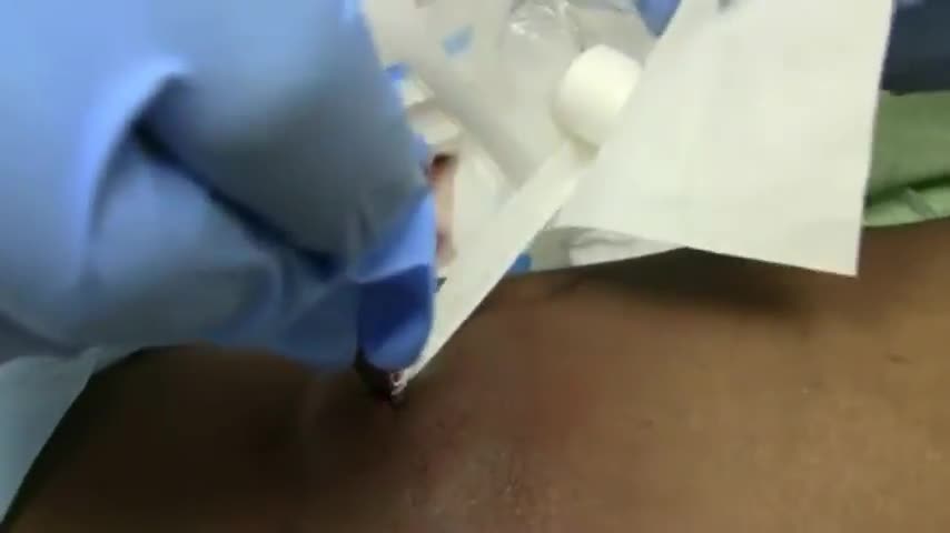 Abscess Drainage