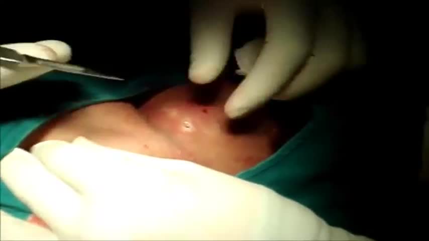 Large Infected Sebaceous Cyst