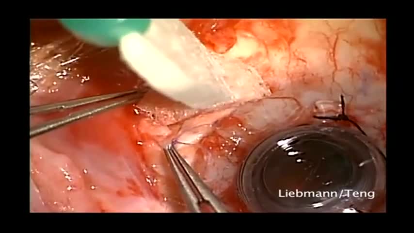 Keratoprosthesis Corneal Transplant