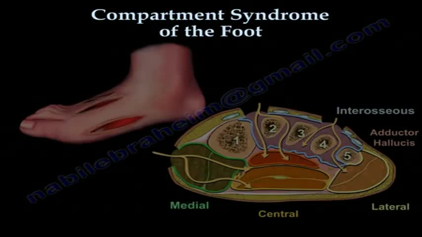 Foot Compartment Syndrome