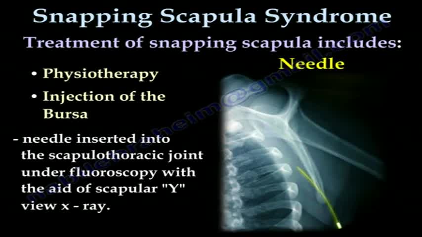 Snapping Scapula Syndrome