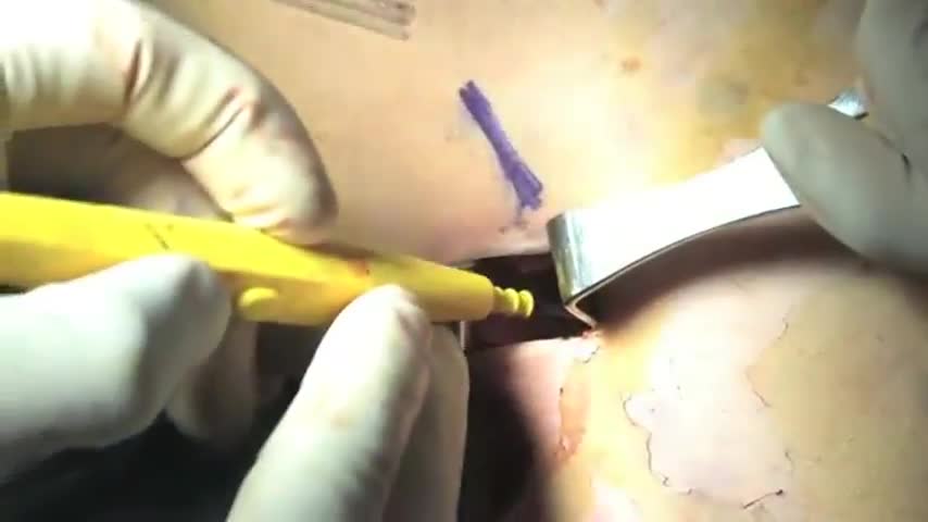 Subpectoral Biceps Tenodesis