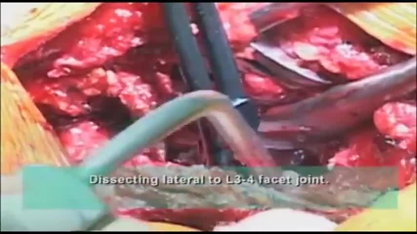 Dissection of the Transverse Process