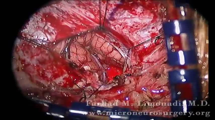 Medulloblastoma Brain Tumor Surgery