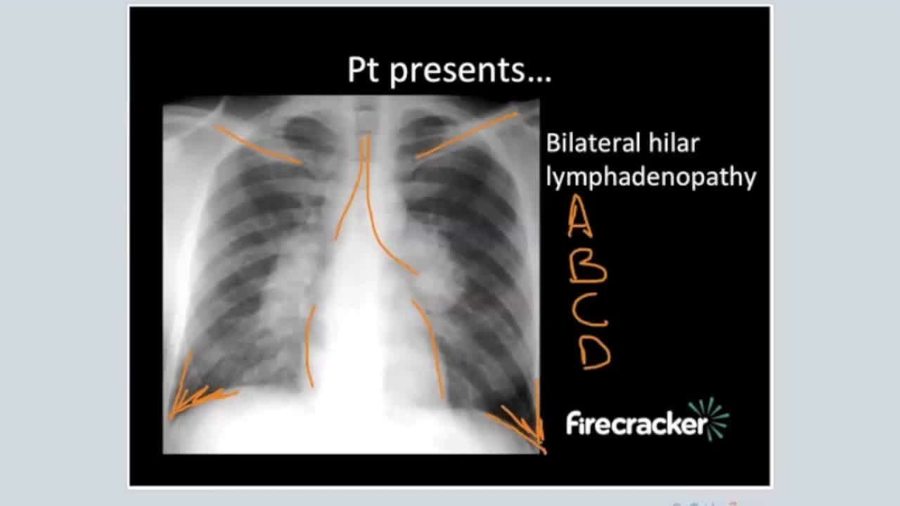 ⁣Sarcoidosis Features